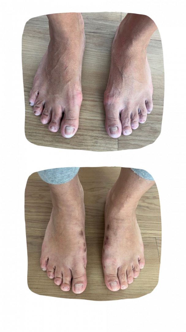 Médico Ortopedista Especializado em Cirurgia de Joanetes