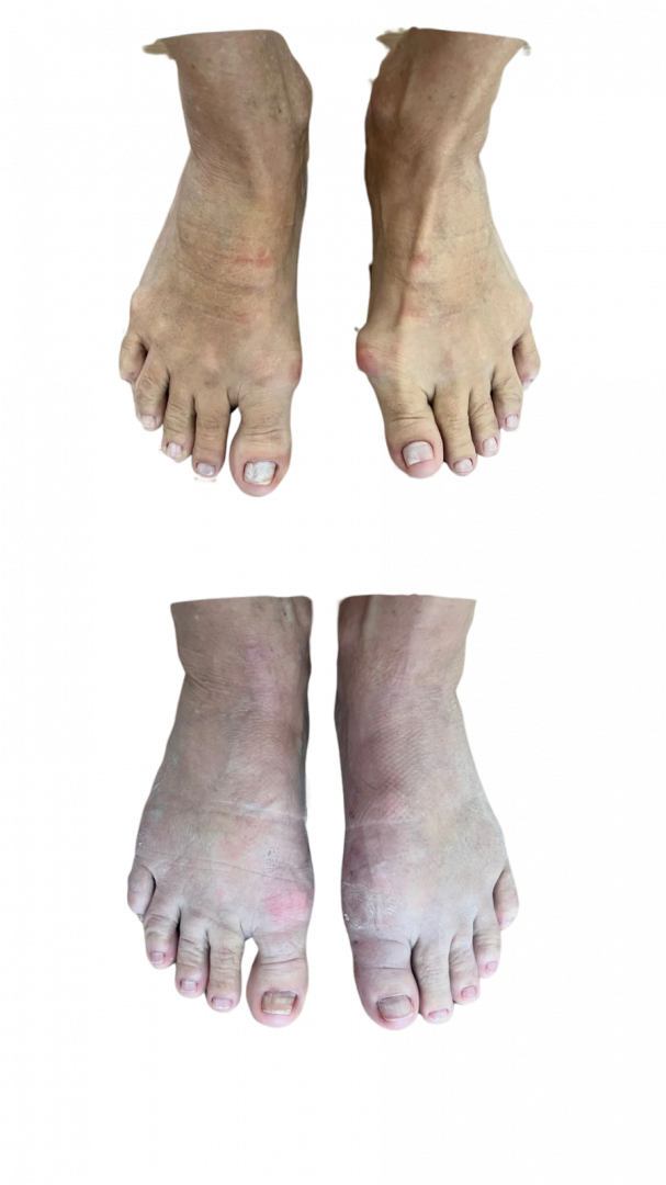 Médico Ortopedista Especializado em Cirurgia de Joanetes